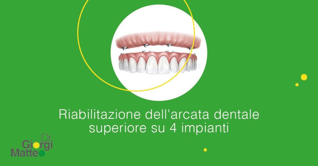 Dentale Distale Prepolare Gomma DamClamp Diga Dentale Morsetto Barriera In Gomma Clip Morsetto In Resina Lungo Corto Odontoiatria Strumenti Di Riparazione Dei Denti - Foto 3
