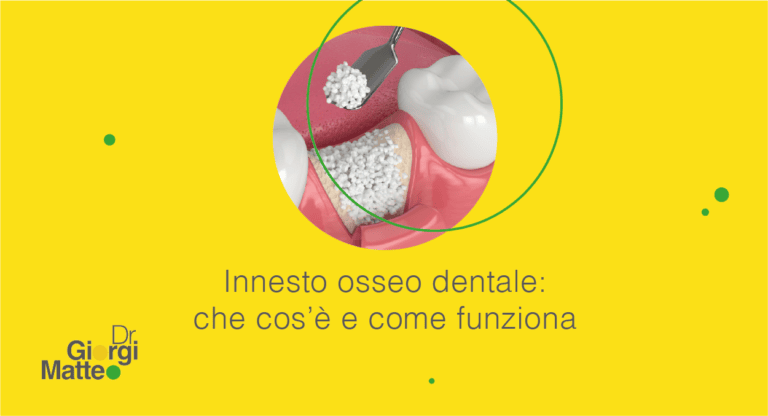 Lima Ossea Chirurgica Dentale 3X Miller - Wise Instruments - Strumento Odontoiatrico - Foto 3